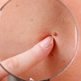 Prevención y tratamiento del cáncer de piel